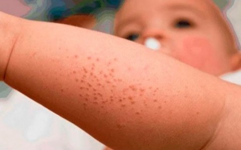 ¿Cómo enfrentar la dermatitis atópica en esta temporada veraniega?