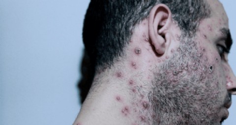 Se confirmó el primer caso de viruela del mono en el país