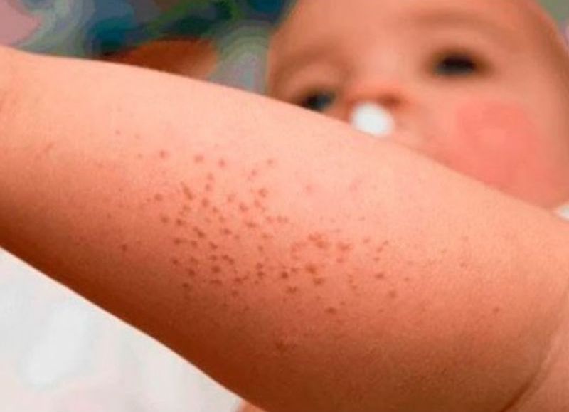 ¿Cómo enfrentar la dermatitis atópica en esta temporada veraniega?